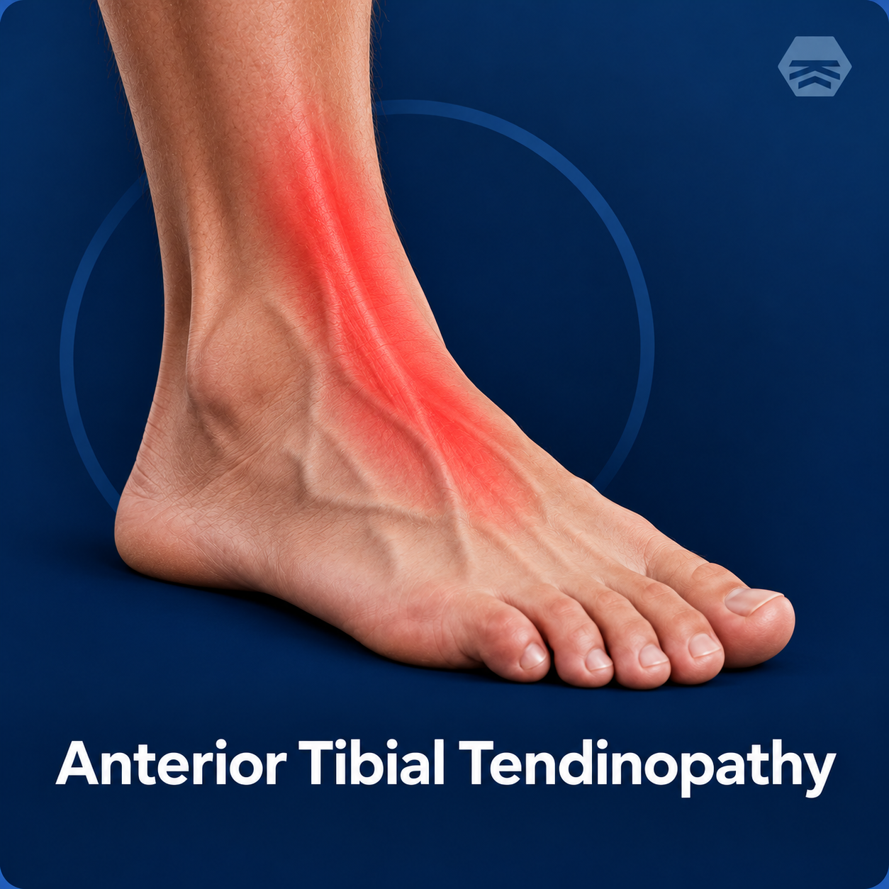 Anterior Tibialis Tendinopathy