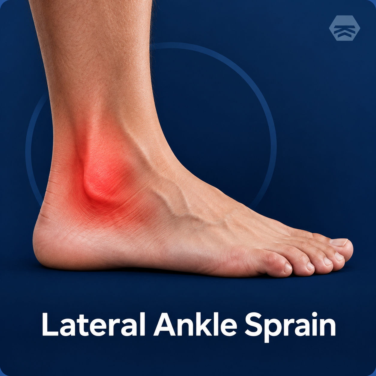 Lateral Ankle Sprain