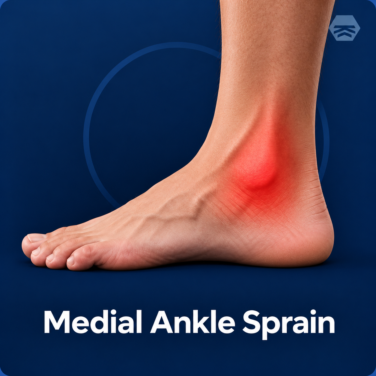 Medial Ankle Sprain