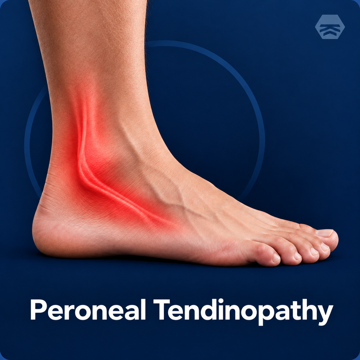 Peroneal Tendinopathy
