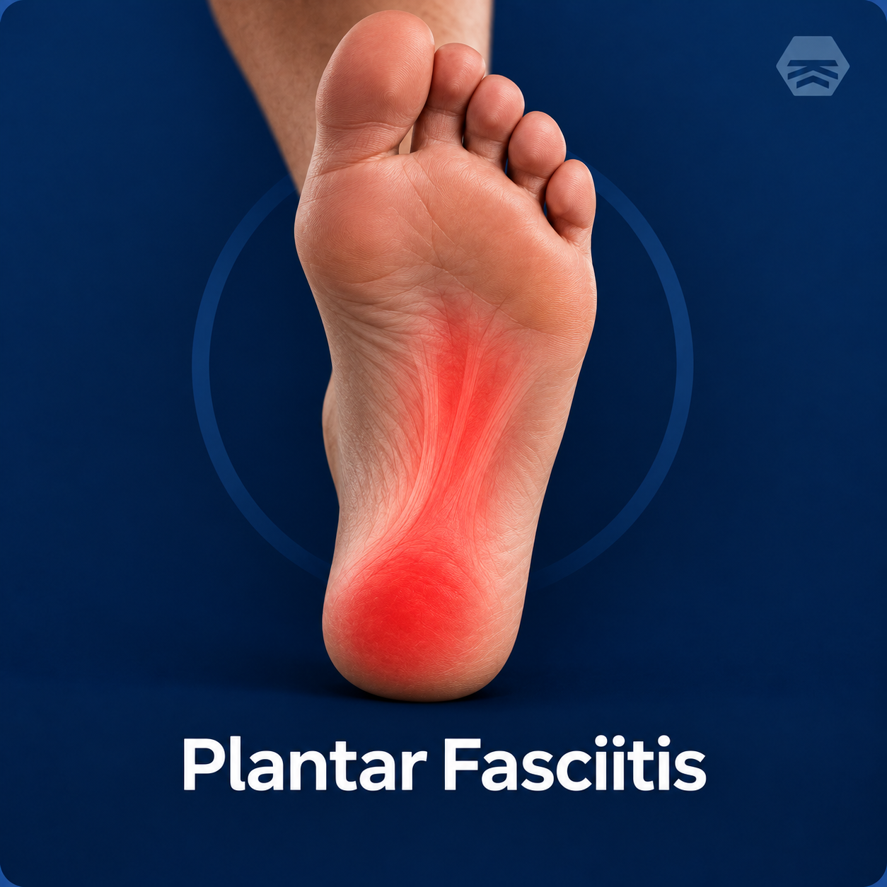 Plantar Fasciitis