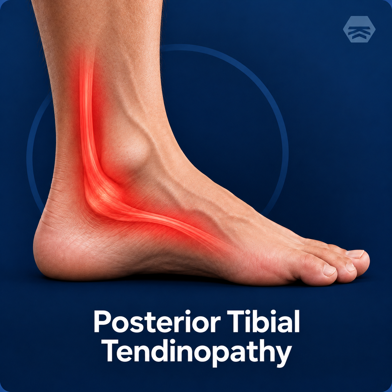Posterior Tibialis Tendinopathy